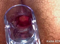 Intense Anal Speculum Gaping On Big Ass Slut With Hairy Pussy